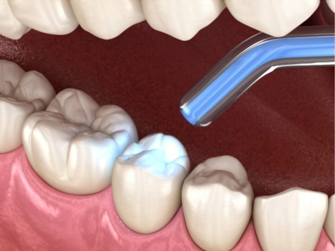 Kompozit Dolgu Neden Tercih Edilir?