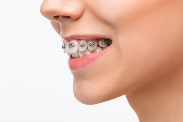 Ortodontist Ne Demektir?